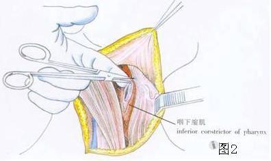 耳鼻咽喉头颈外科手术征集保留喉功能的梨状窝癌切除术