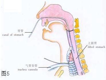 環後t2期和t3期癌切除胃上提整復:翻起頸部皮瓣充分顯露喉,氣管.