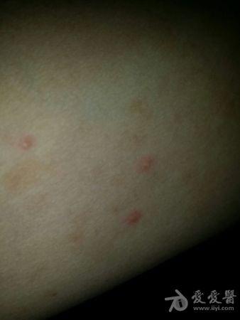 开始发出来的样子，上有水泡