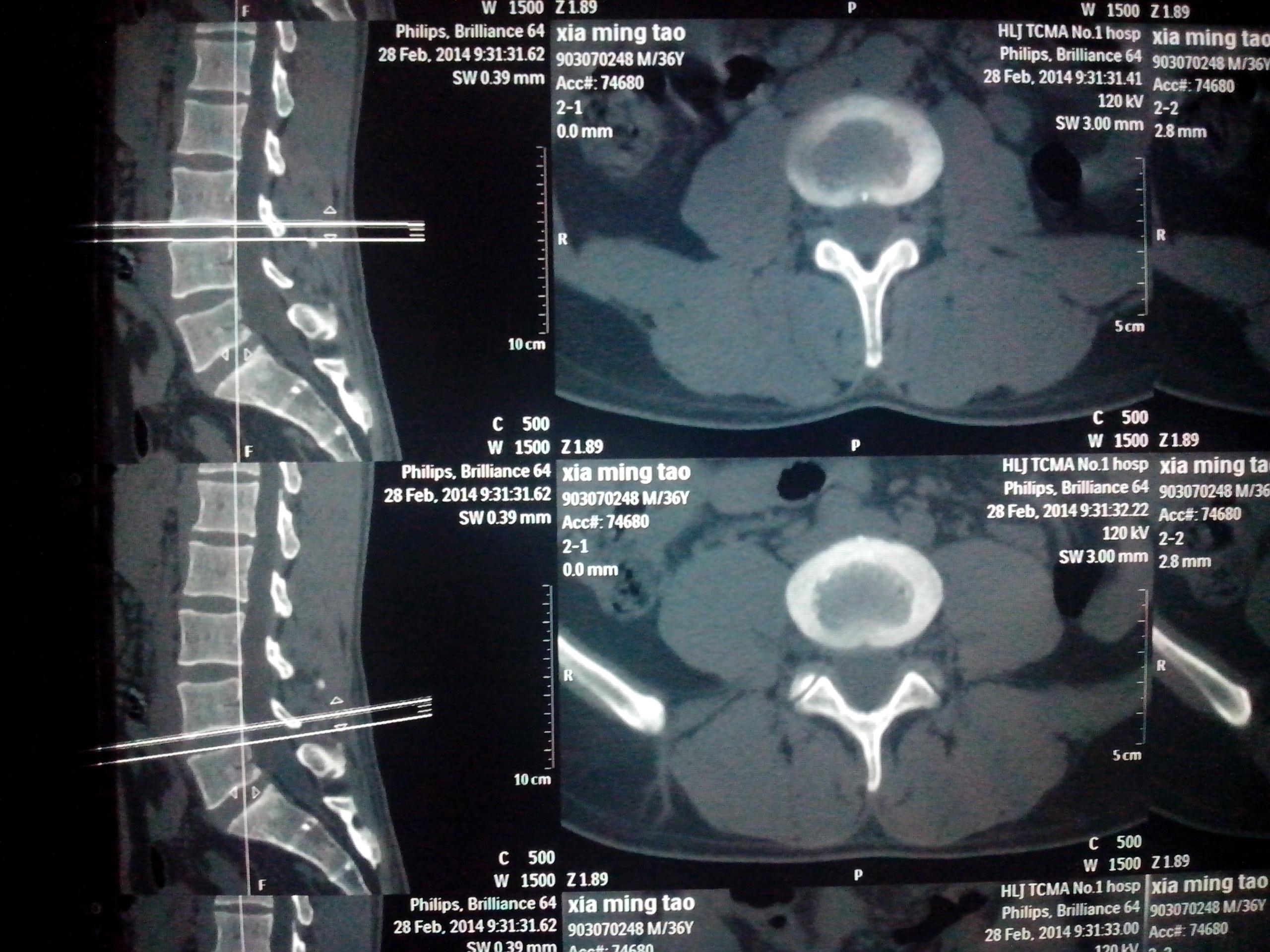 腰椎间盘突出,l5和骶骨峡部不连,左侧骶髂骨错缝!