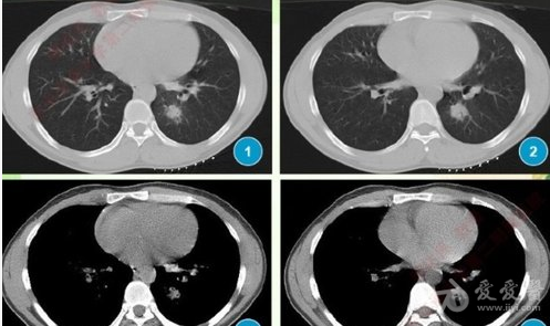 病变周围未见有卫星病灶.    纵膈窗:病变较肺窗小