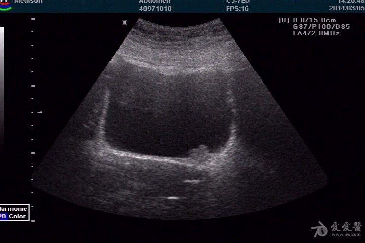 膀胱长息肉的彩超图片图片