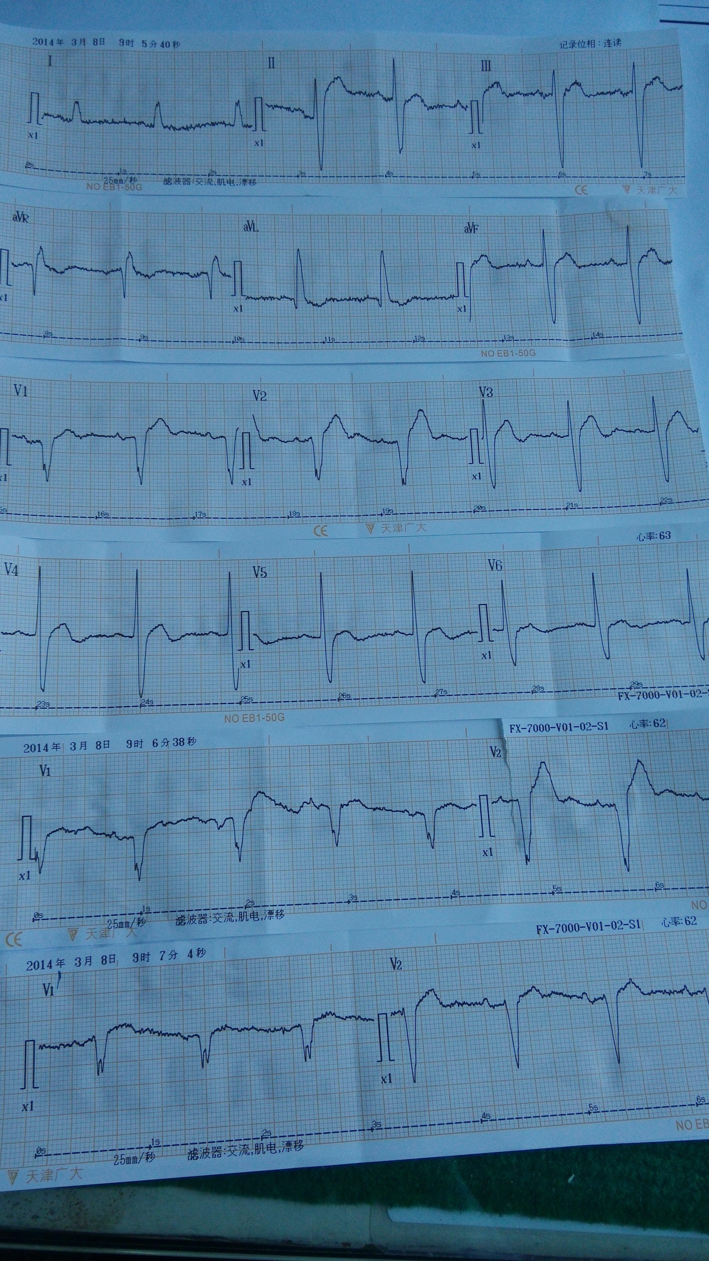 不像左束支,也不像左前 - 心电图脑电图专业讨论版 - 爱爱医医学论坛