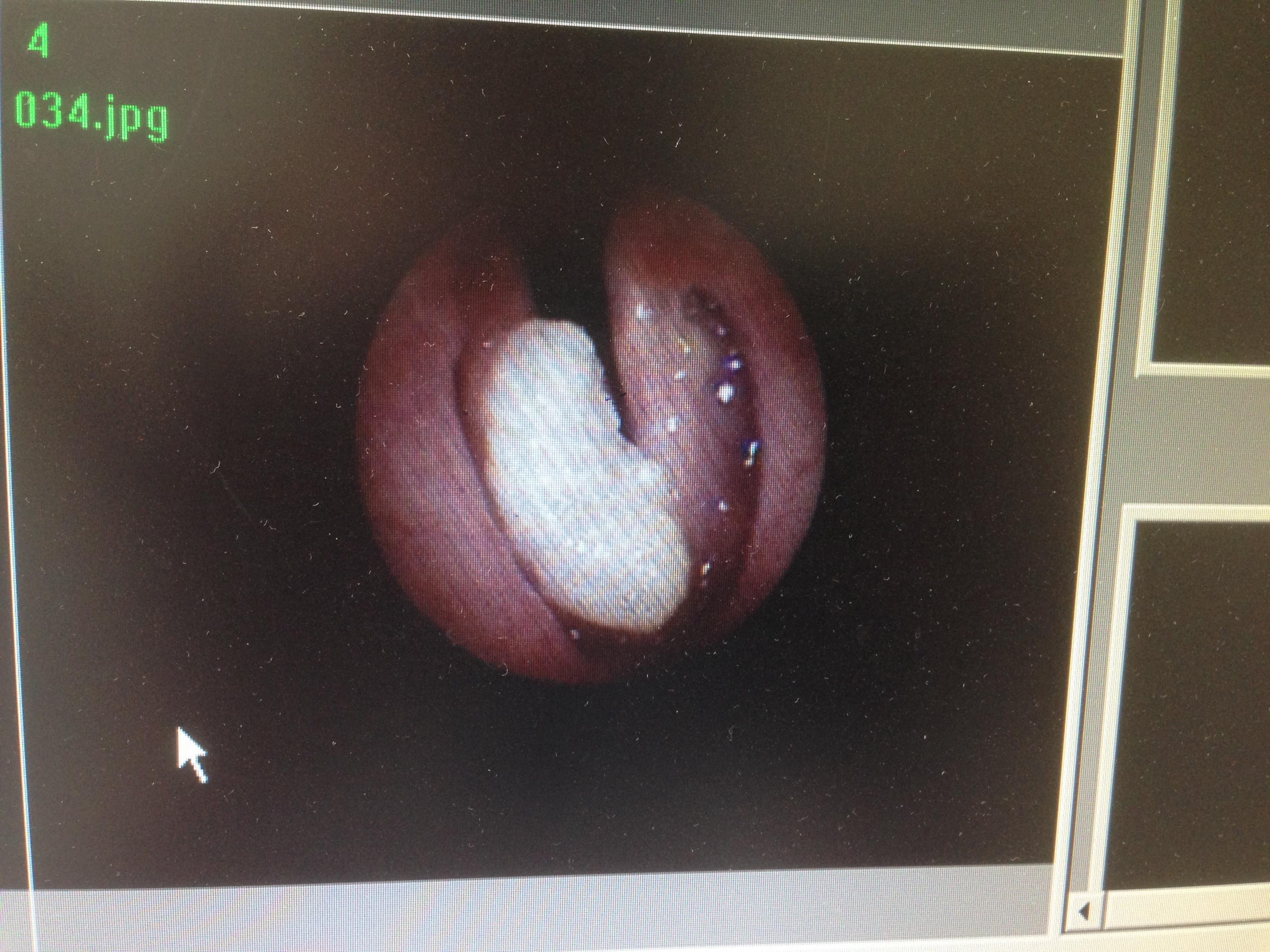 喉咙鳞状细胞癌图片