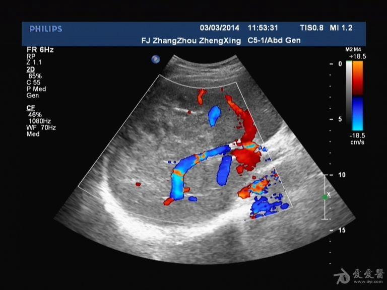 肝脓肿两例 - 超声医学讨论版 - 爱爱医医学论坛