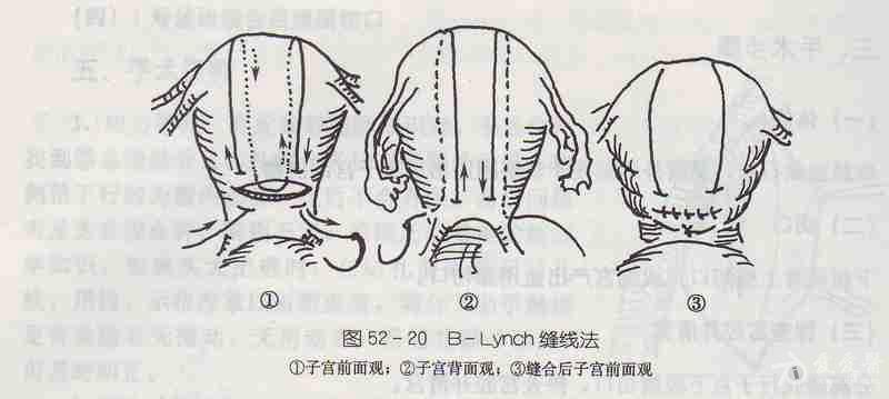 子宫背带式缝合术步骤图片