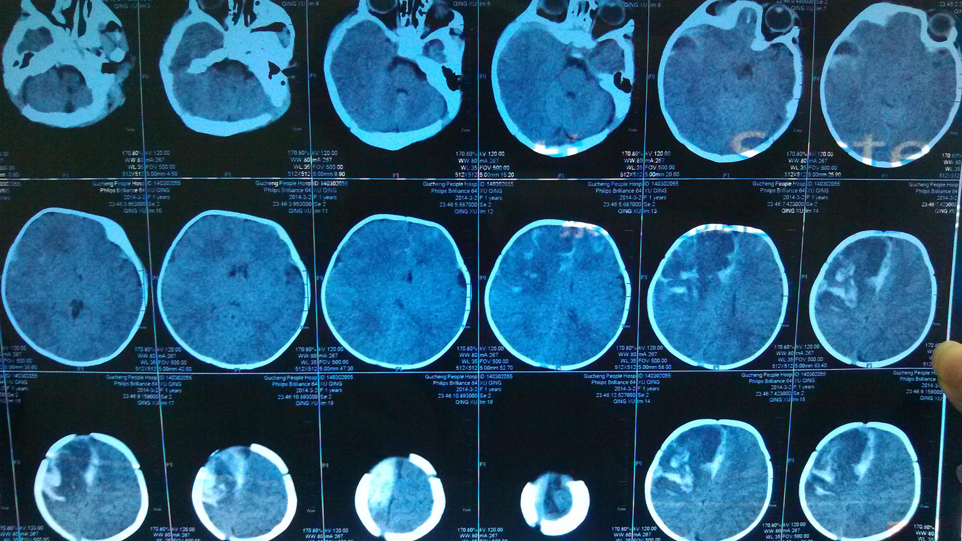 脑震荡ct图片 片子图片