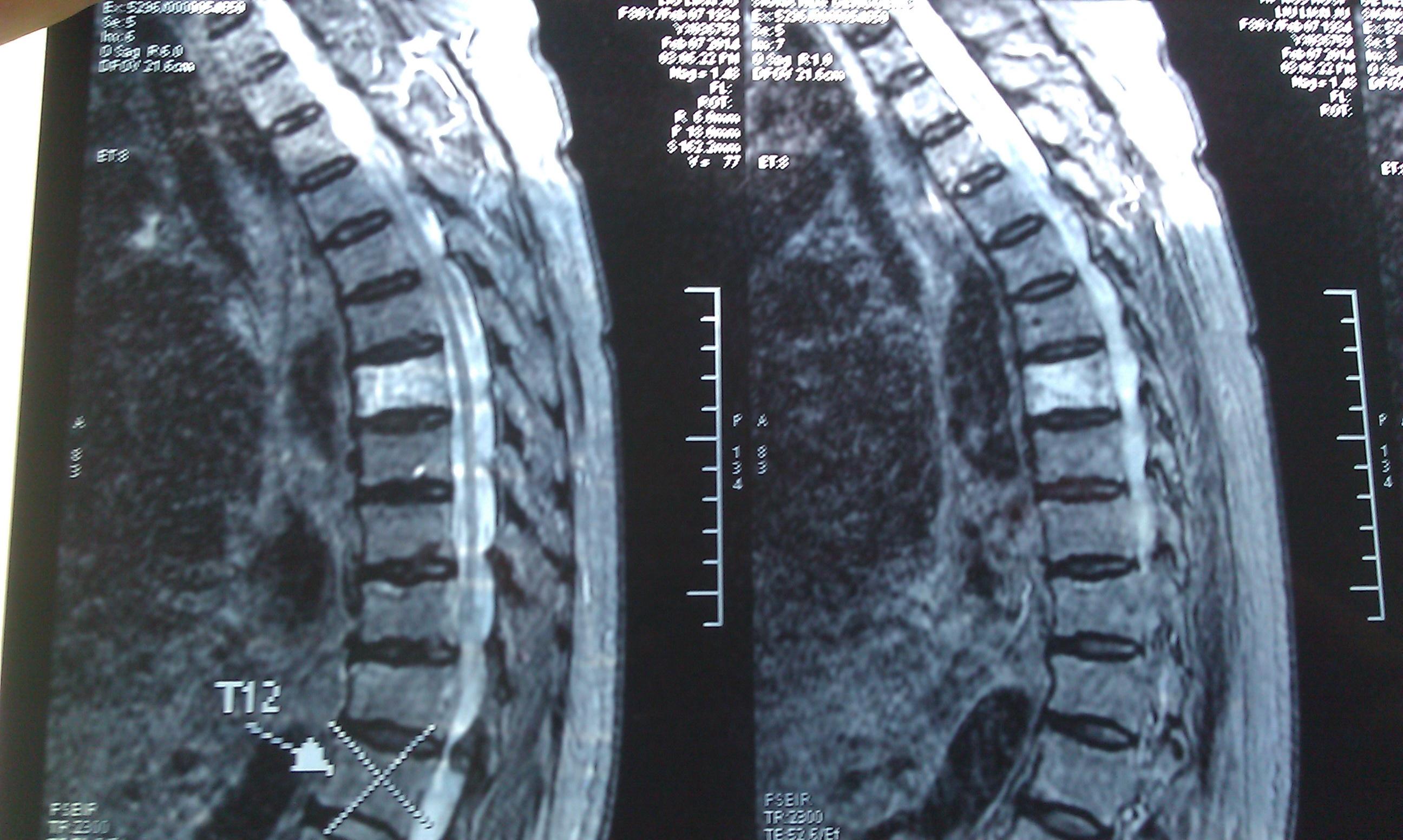 胸椎磁共振平扫图片图片