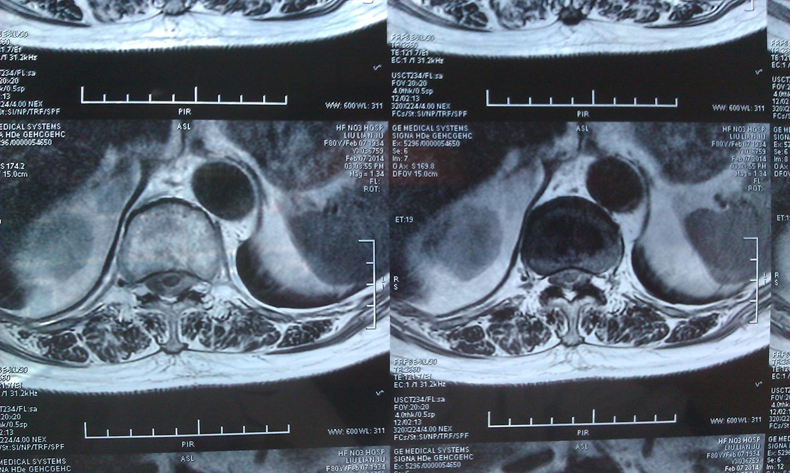 看一例胸椎mri