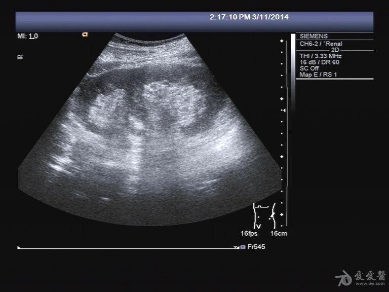 重复肾超声表现图片图片