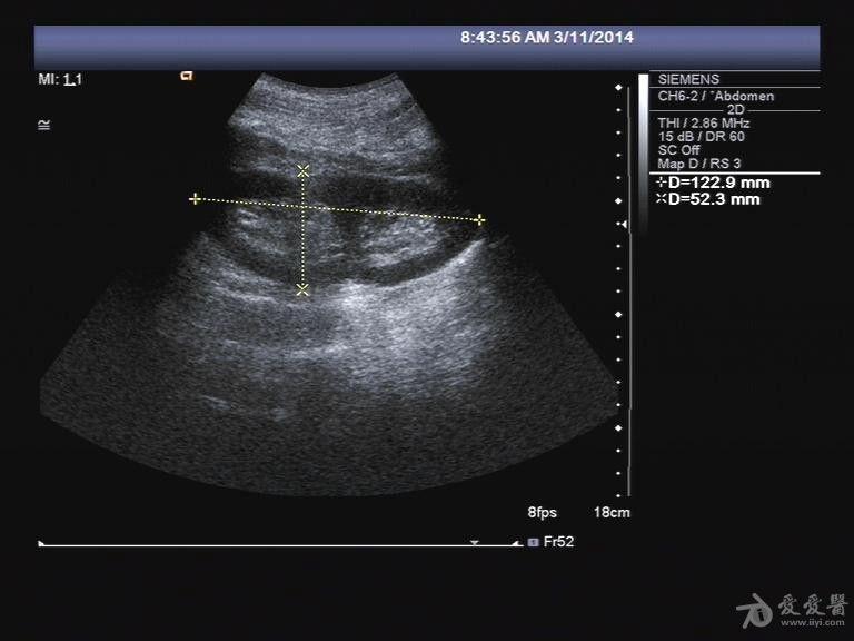 重复肾超声表现图片图片
