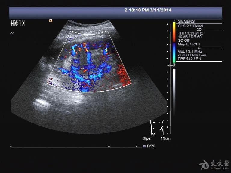 胎儿重复肾超声图片图片