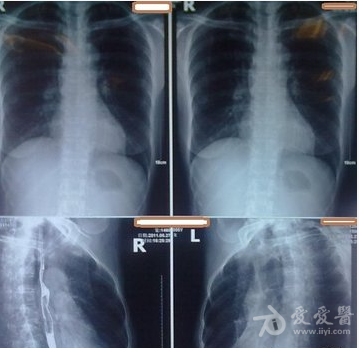 气胸引流瓶的原理是什么_什么是开放是气胸(2)