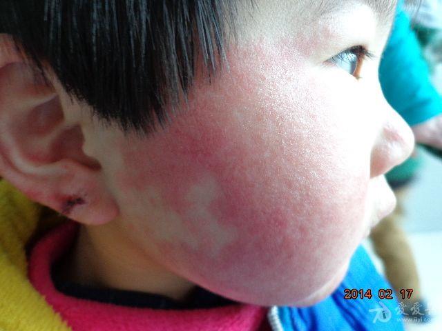 接触性皮炎化妆品皮炎并沙土皮炎