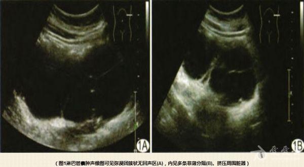 成人肠系膜淋巴管囊肿 医学影像学讨论版 爱爱医医学论坛