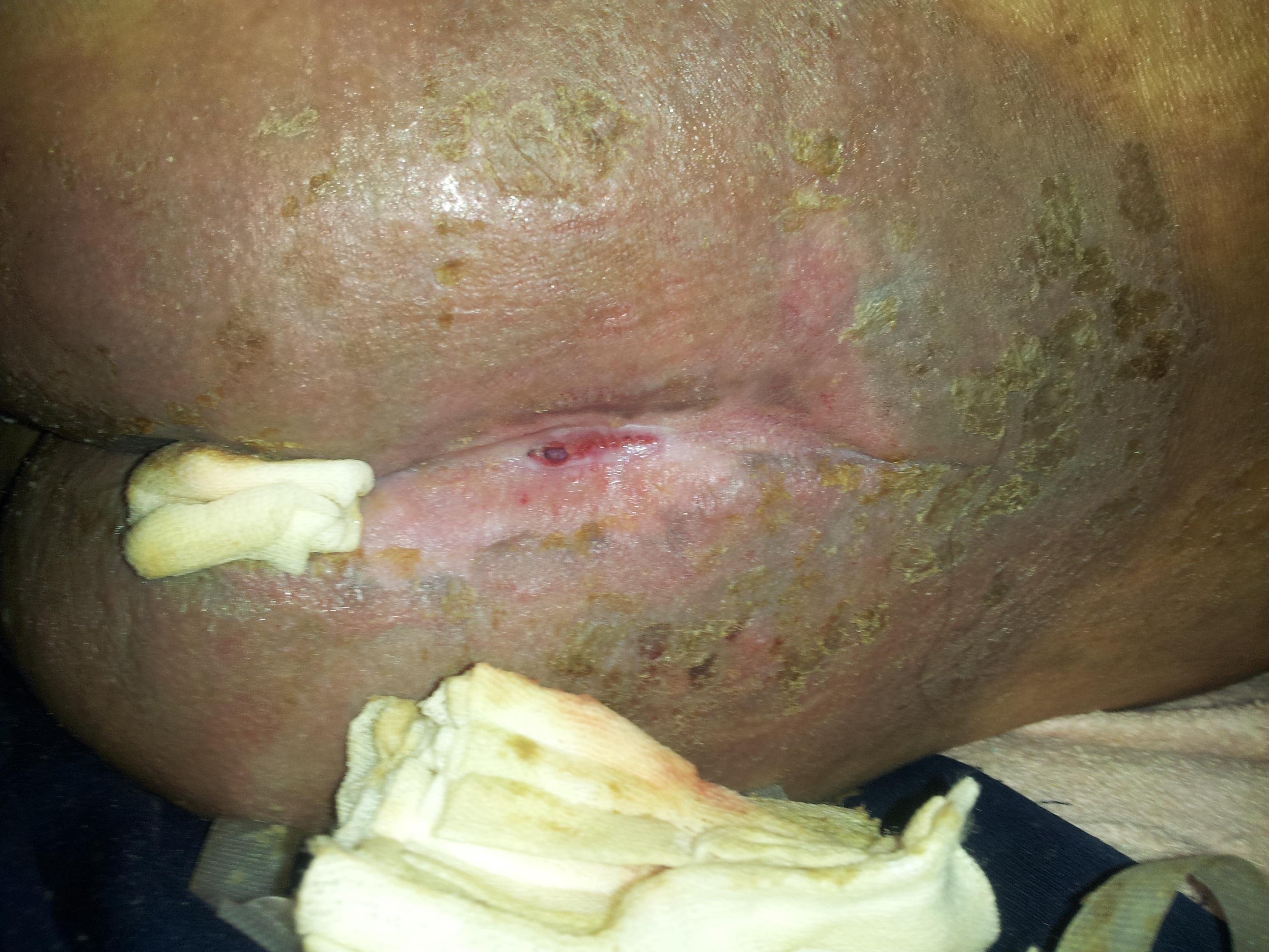 3个月治愈背部巨大褥疮海藻敷料治疗病例1例