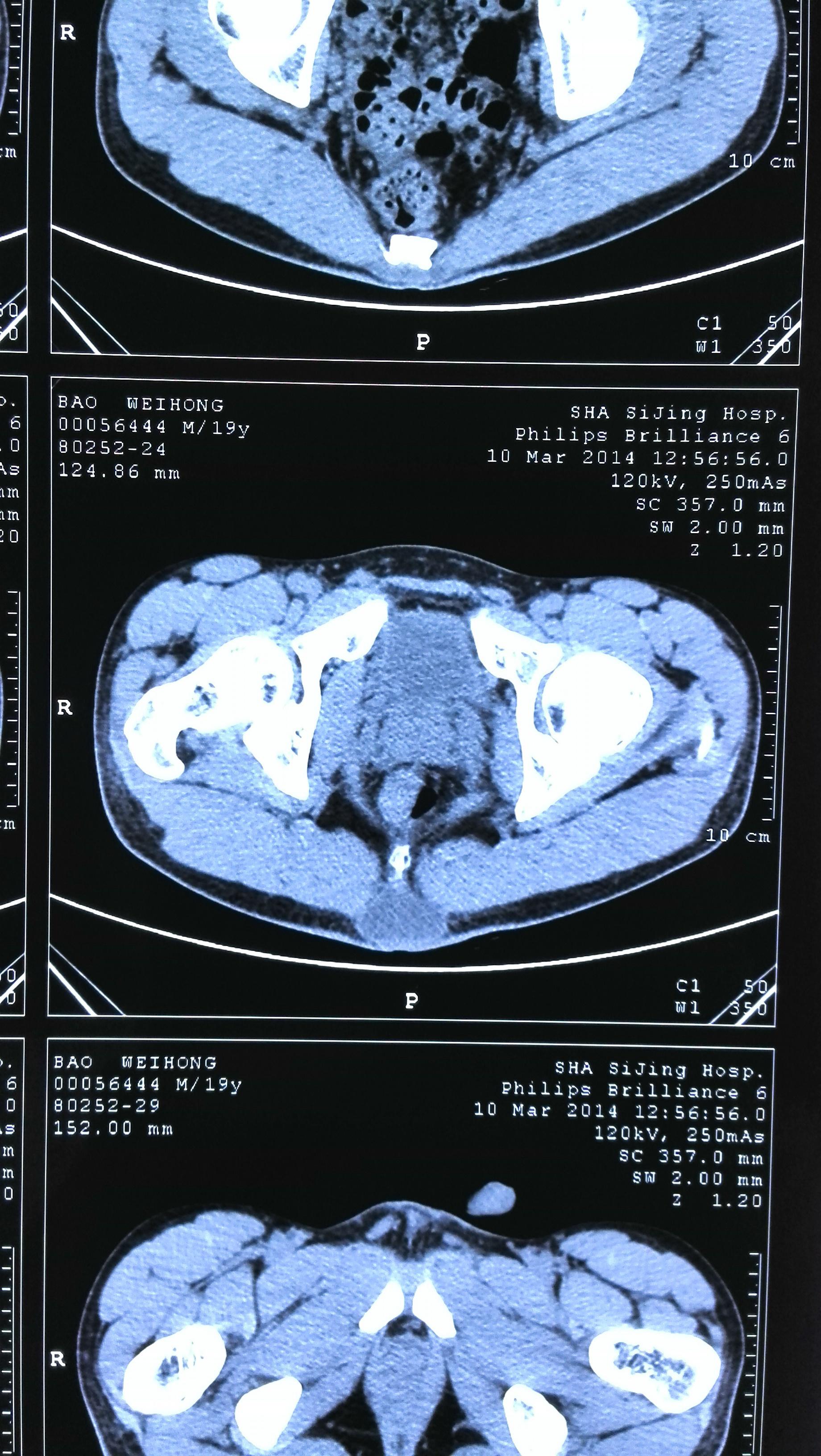 骶髂关节 MRI 如何诊断早期强直性脊柱炎_软骨