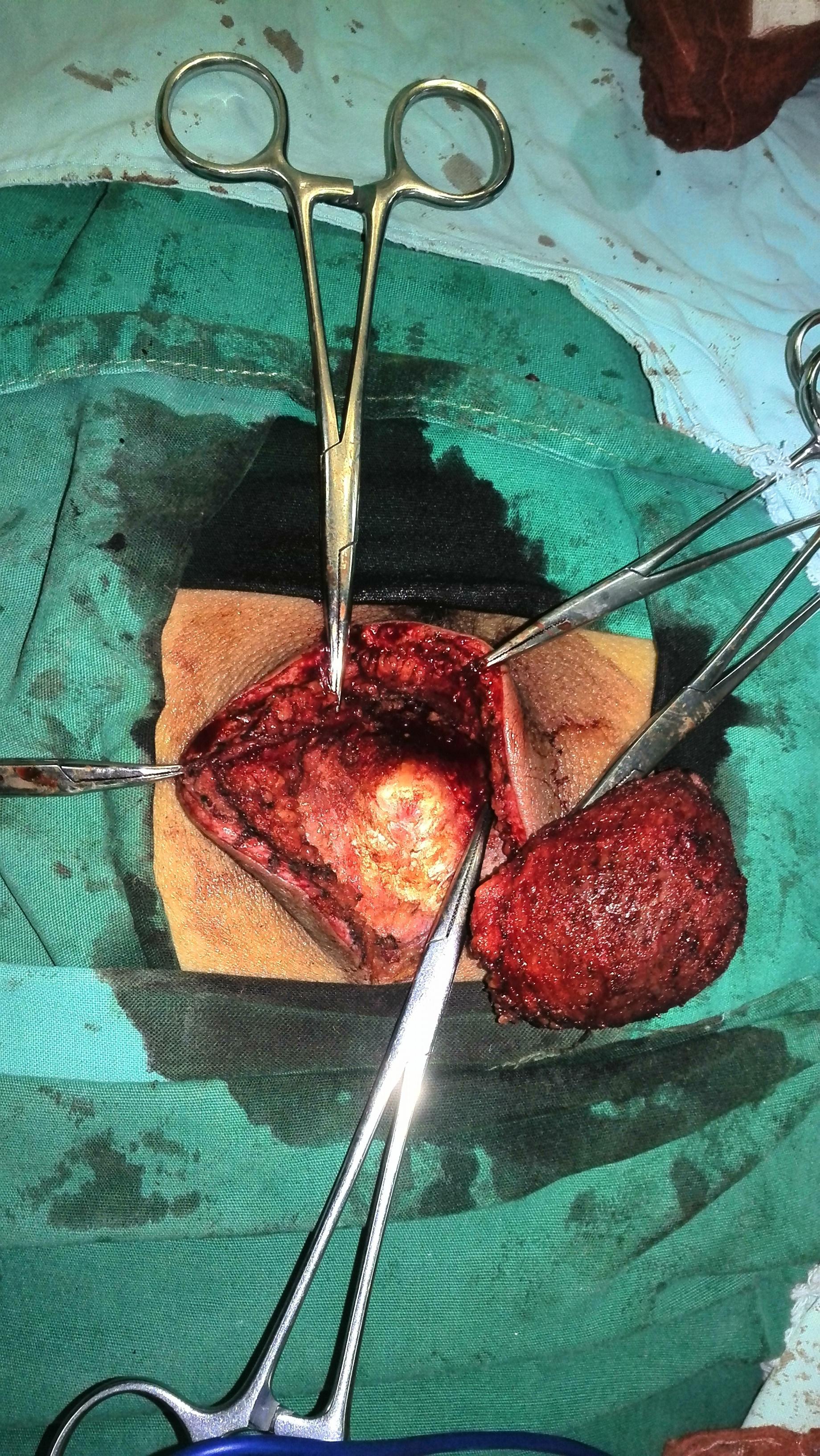 骶尾部脂肪瘤图片图片