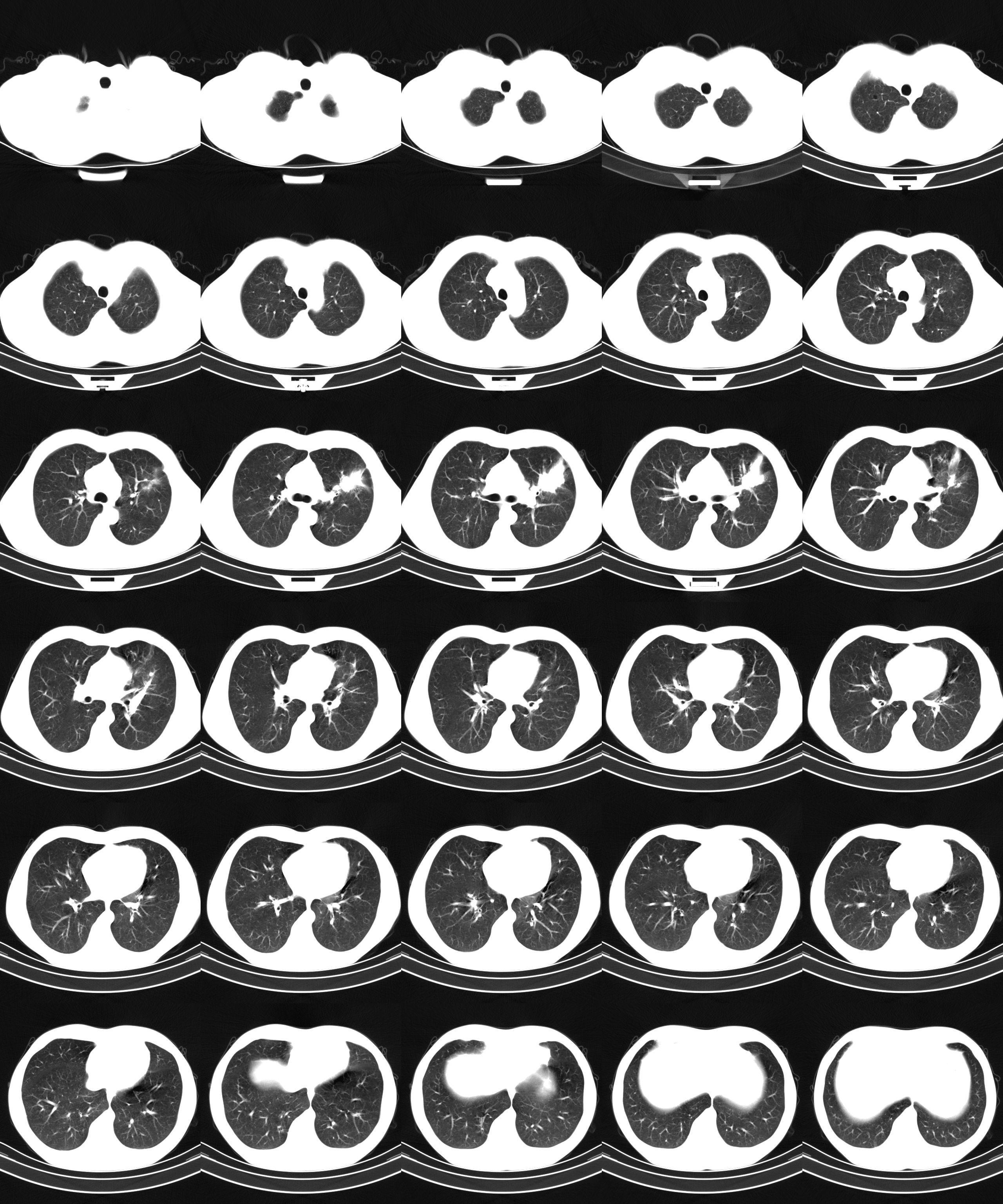 正常肺CT图片图片