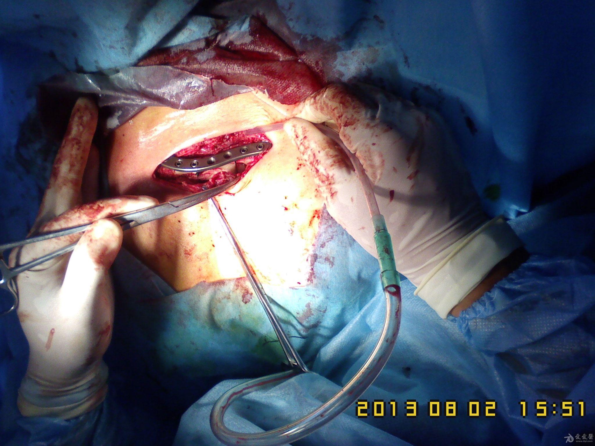 锁骨骨折微创手术图片