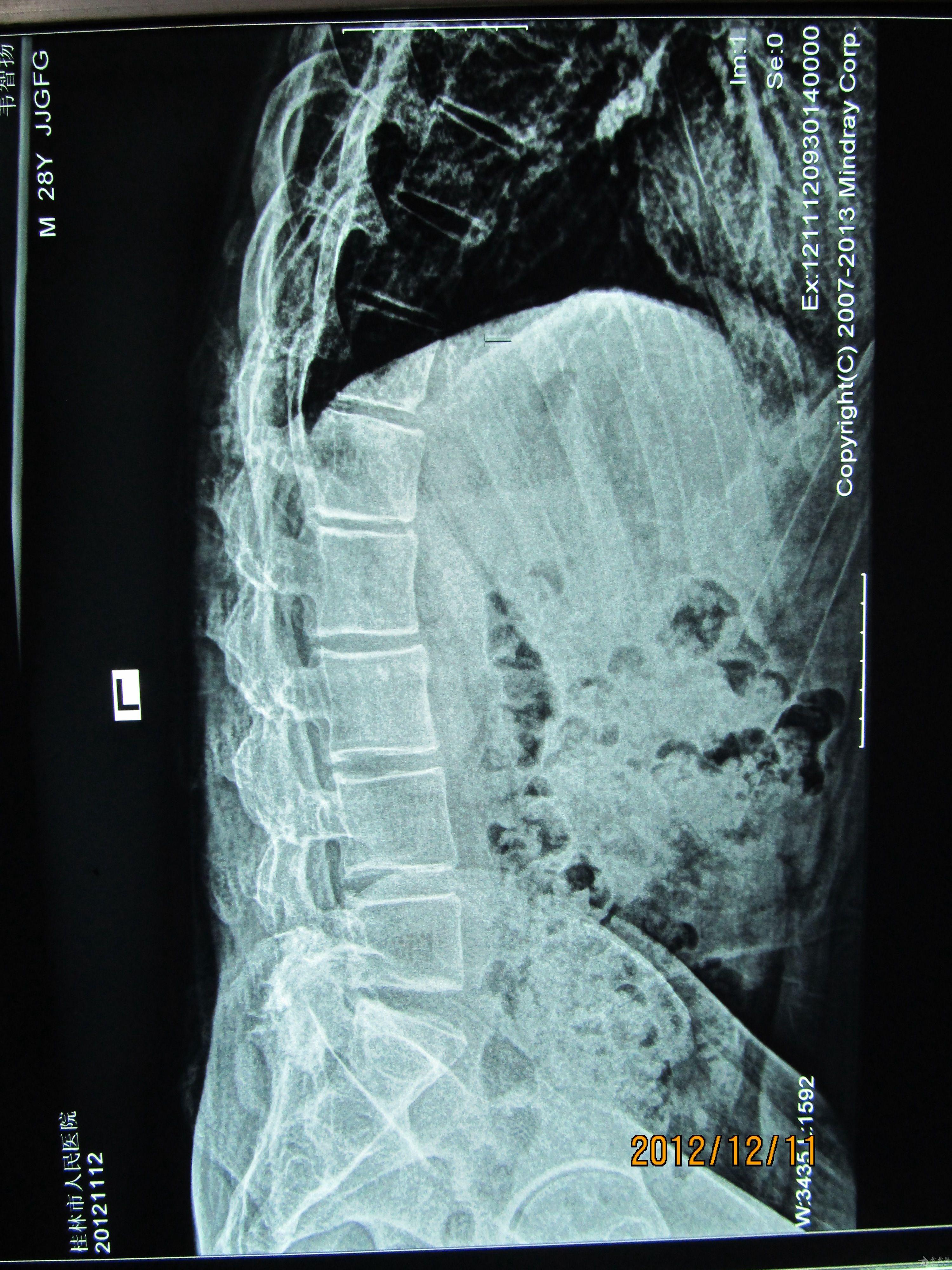 强直性脊柱炎中期图片图片