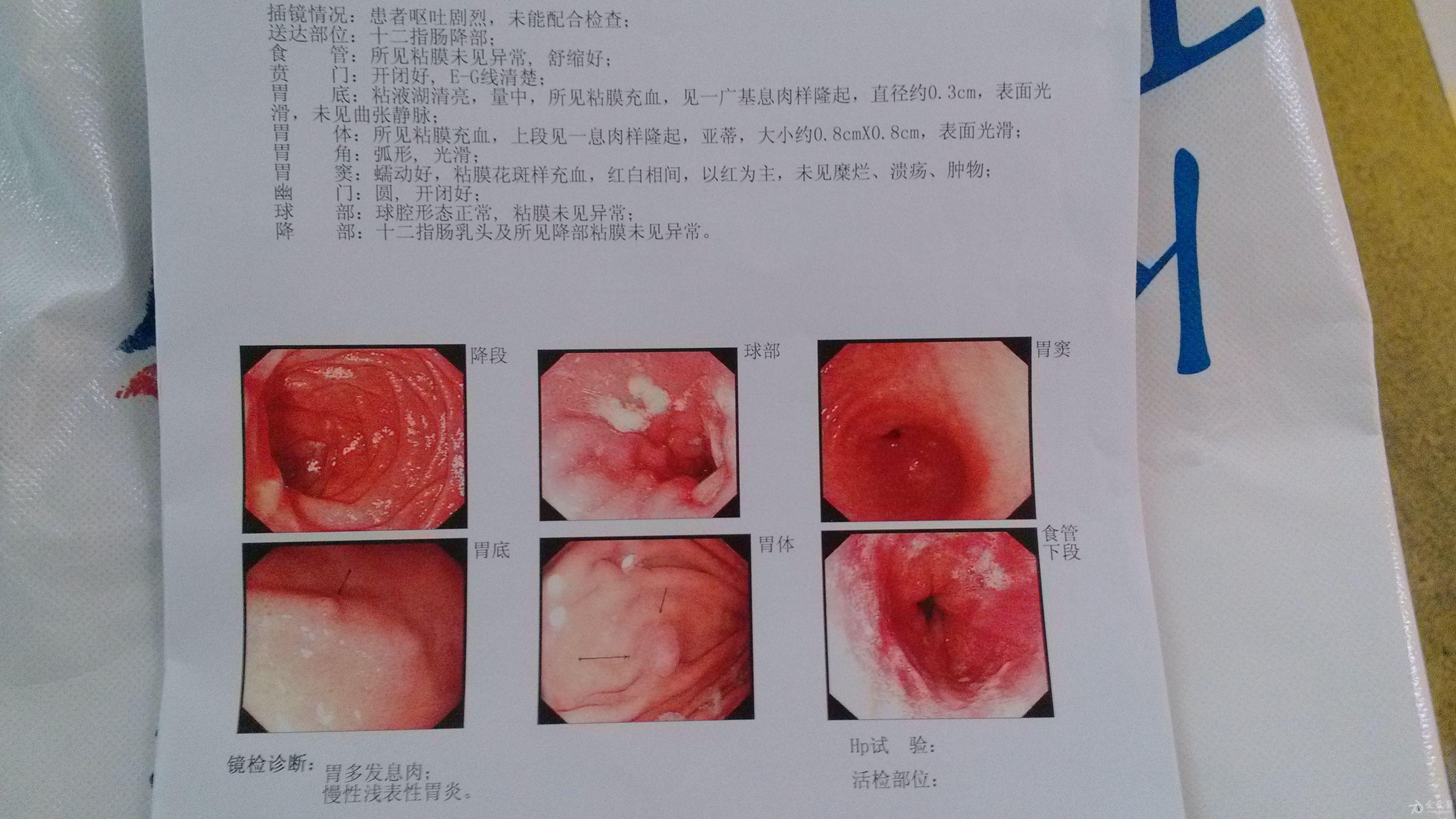 胃息肉用中医可以怎么治疗?