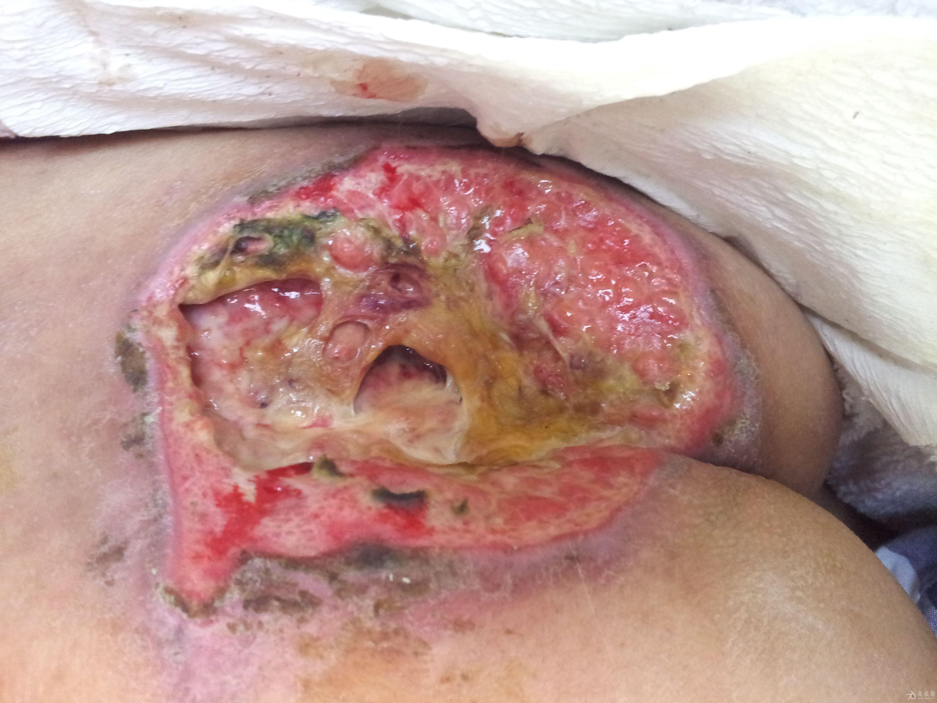 3个月治愈背部巨大褥疮海藻敷料治疗病例1例