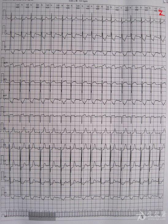 交界性自主心律心电图图片