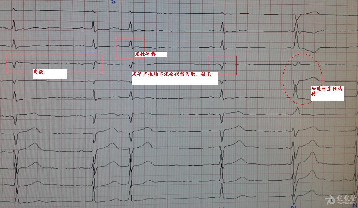 房室分离心电图图片