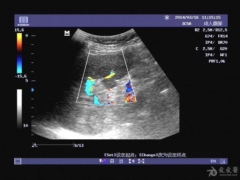 常规体检副脾? - 超声医学讨论版 - 爱爱医医学论坛