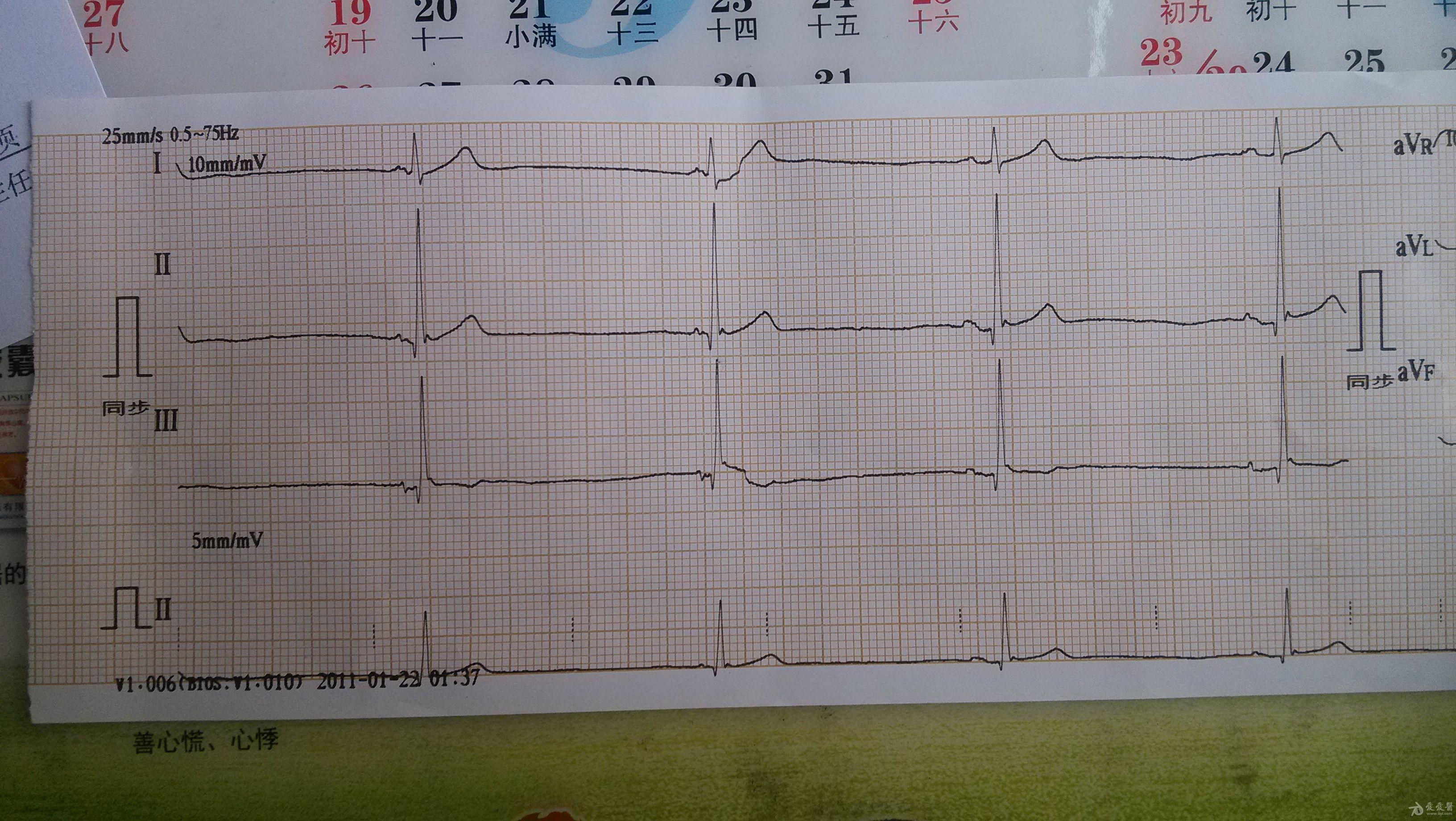 图片有点大,心律有点慢 - 心电图脑电图专业讨论版 - 爱爱医医学论坛
