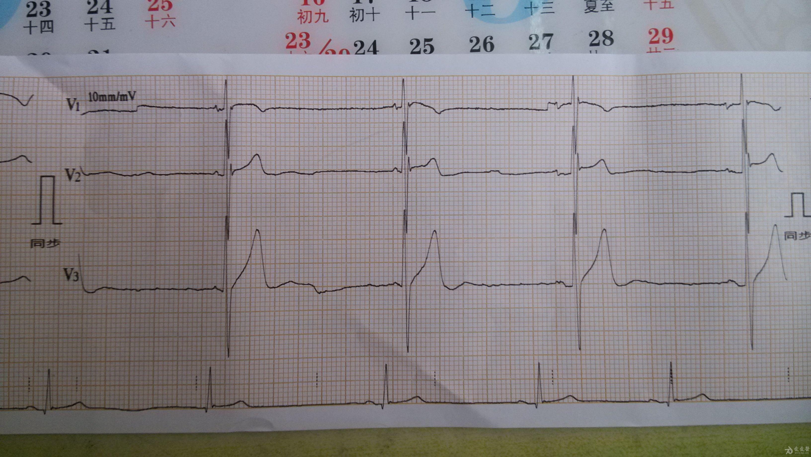 圖片有點大,心律有點慢 - 心電圖腦電圖專業討論版 - 愛愛醫醫學論壇
