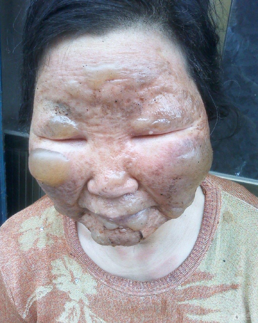 同样度数的烧伤,面部烧伤最易愈合