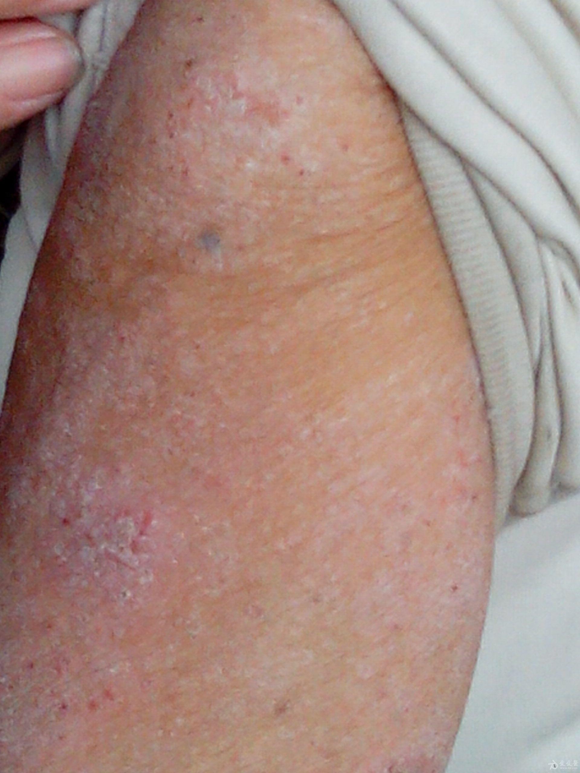 梅毒皮肤溃疡图片图片