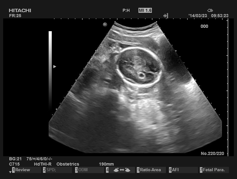 侧脑室脉络丛囊肿一例