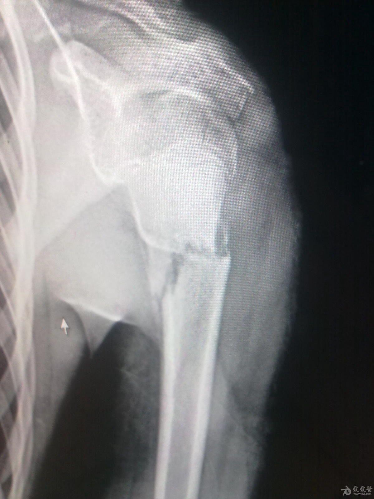 肱骨近端骨折斜位成角角度预后会不会塑形成功