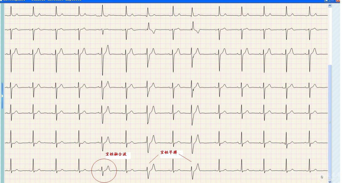 請山羊老師和版主看看,這個圖是什麼 - 心電圖腦電圖專業討論版