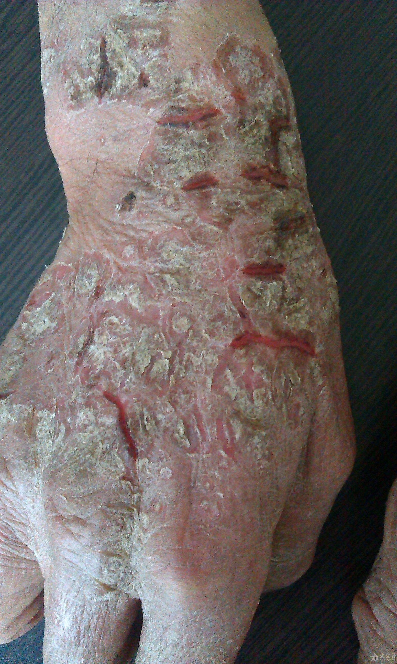 疟疾皮肤图片图片