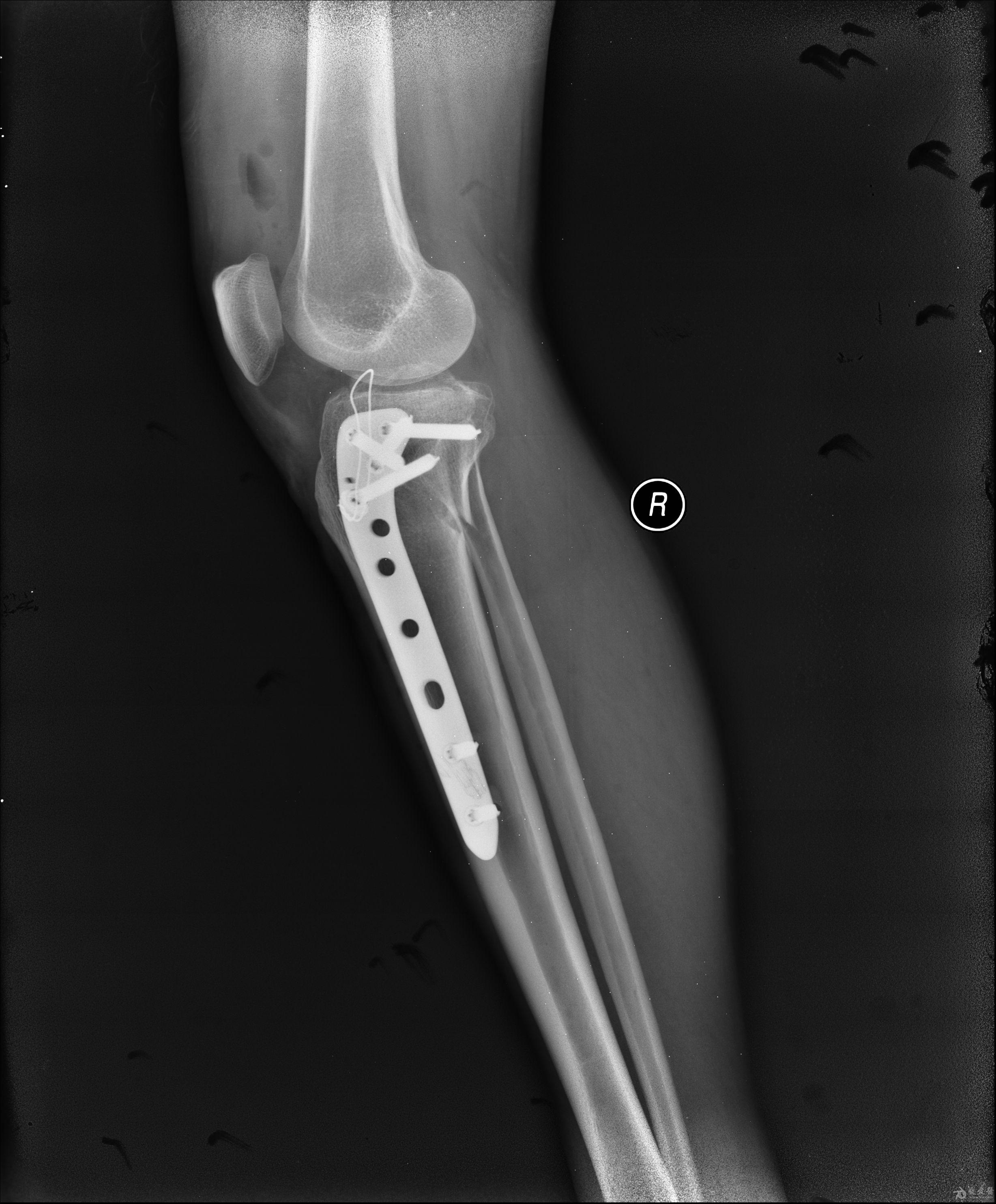 右胫骨平台骨折图片图片