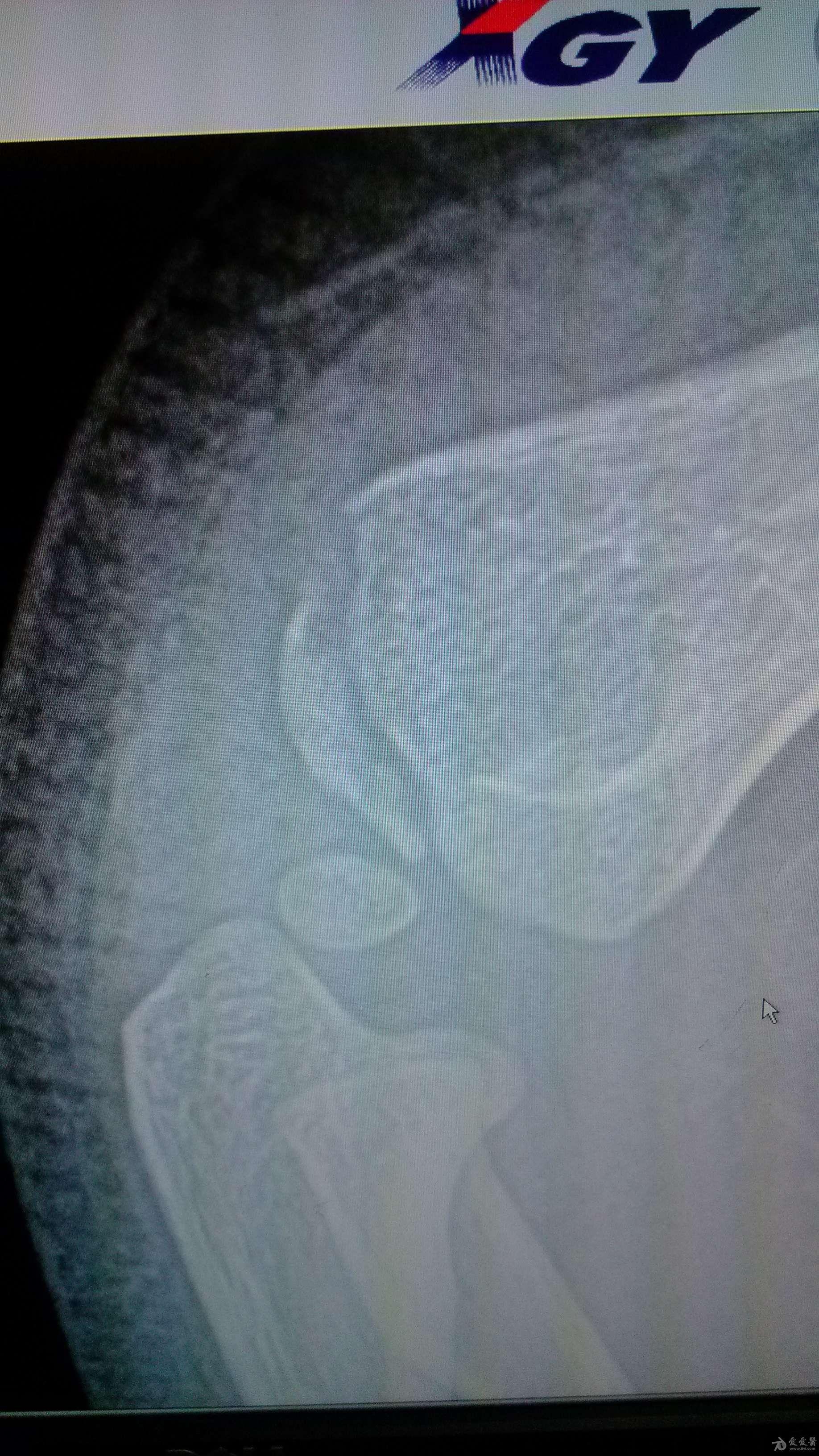 【骨科群内病例】肱骨外髁骨折伴骨骺损伤