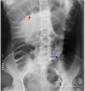 回肠梗阻鱼肋征图片图片