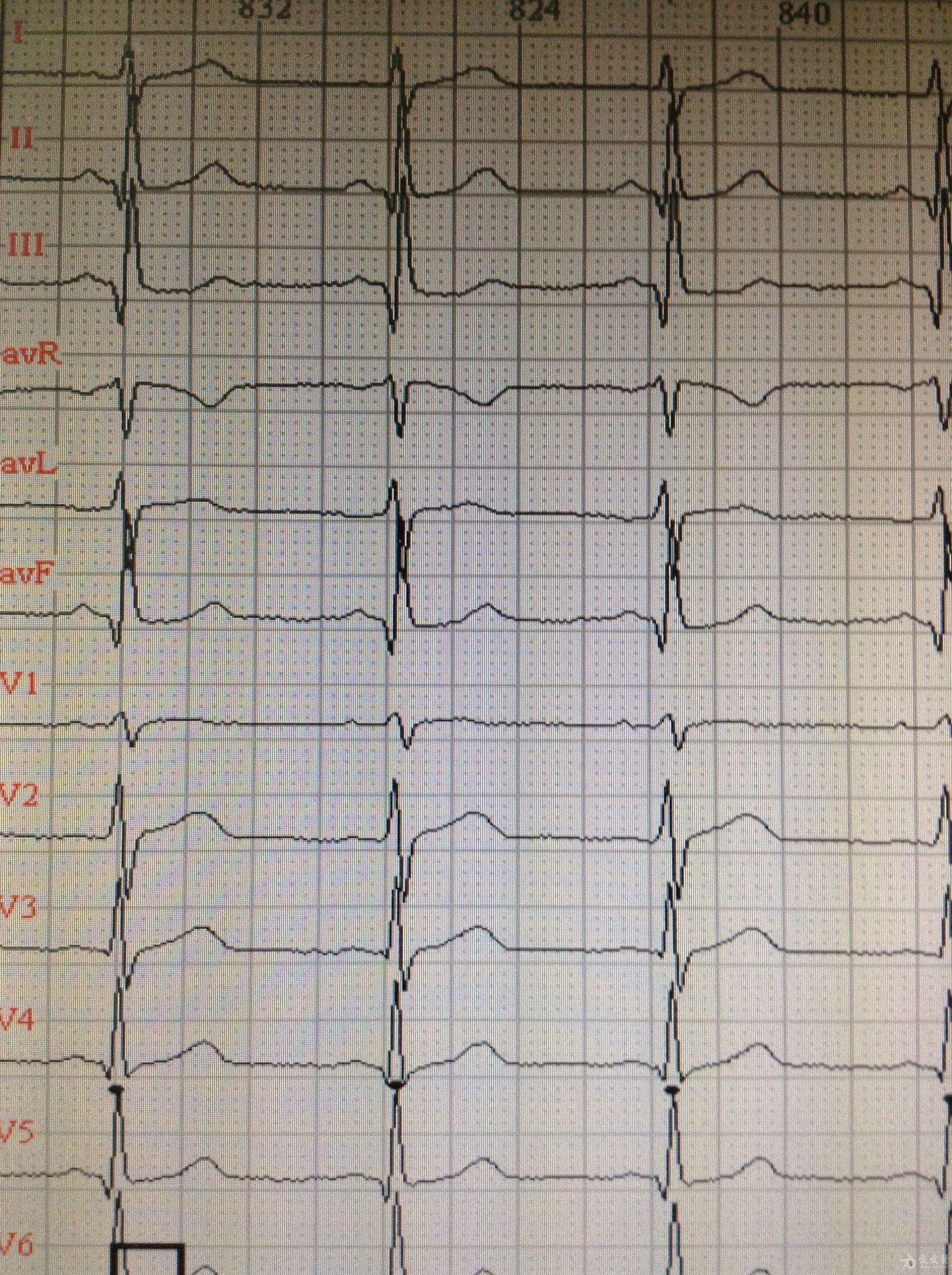 心电图avf图片