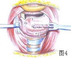 耳鼻咽喉头颈外科手术征集——声带癌垂直喉部分切除术