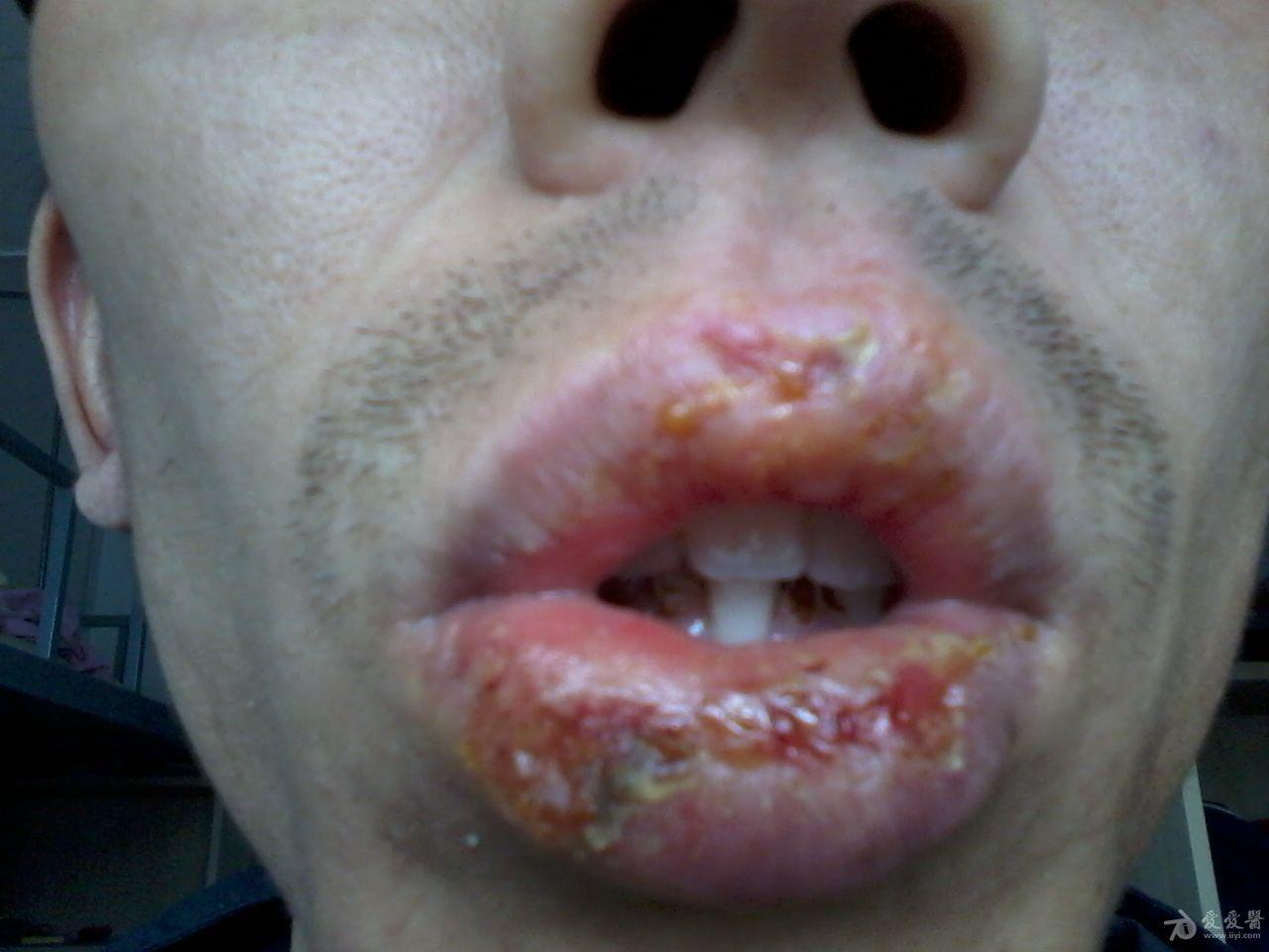 唇膜炎是什么症状图片图片