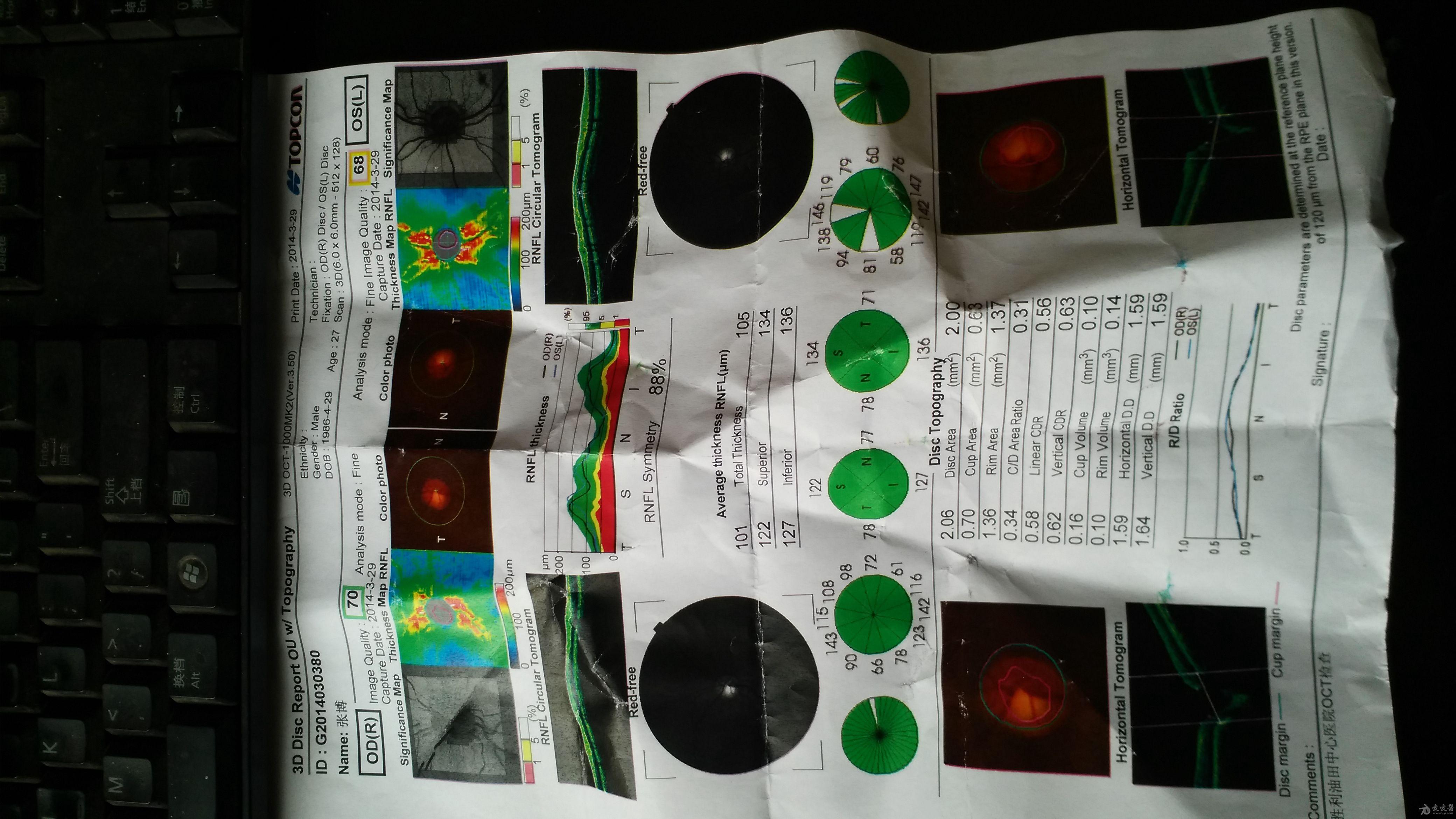 求教,眼部oct看不明白 眼科专业讨论版 爱爱医医学论坛