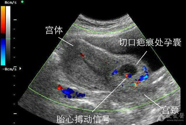 瘢痕子宫超声图片