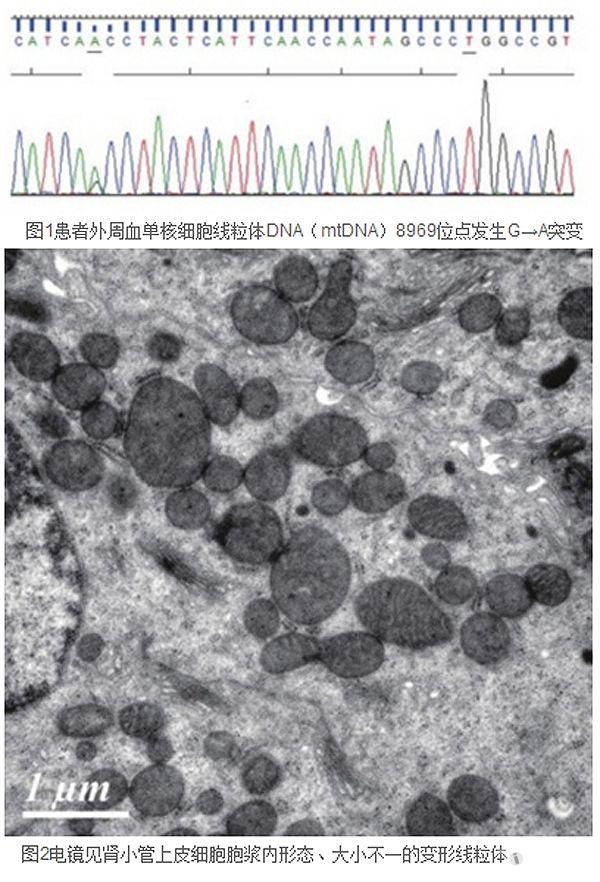 【閱讀】線粒體病一例