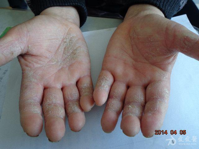 手部角化型湿疹