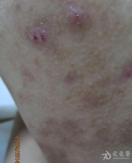 求有经验的皮肤科医生帮忙看看此为马拉色菌毛囊炎还是痤疮多图