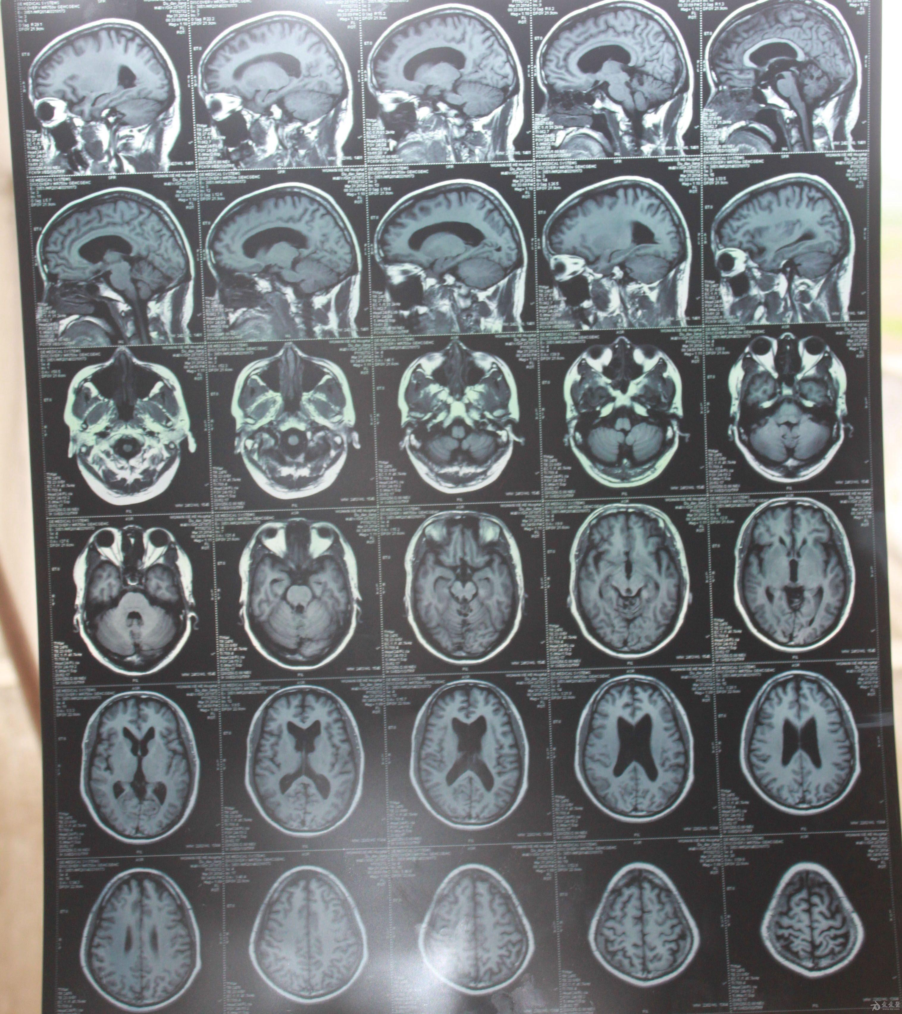 mr检查报告病例
